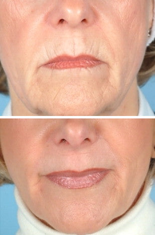 Perioral rejuvenation lip lines/barcode lines/smoker’s lines)