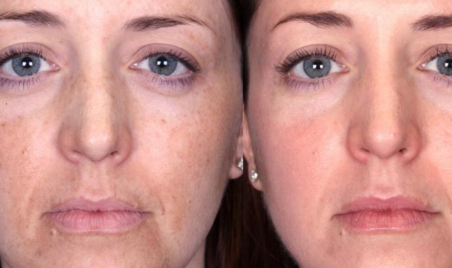3 Sessions IPL Photofacials