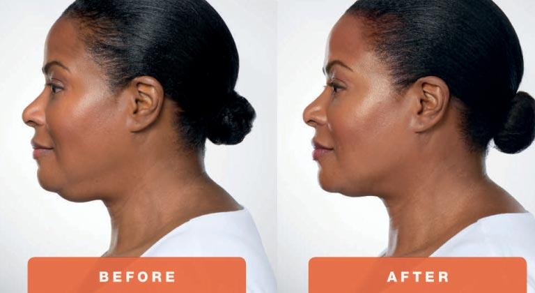 Belkyra Under the chin 2 vials (Not shipped, clinic use only)