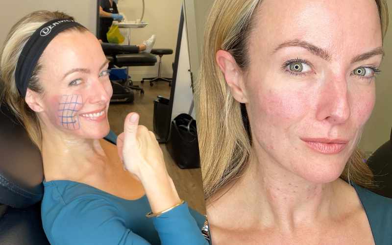 3 Syringes Radiesse Face, Neck or Hand Rejuvenation (not shipped, clinic use only)