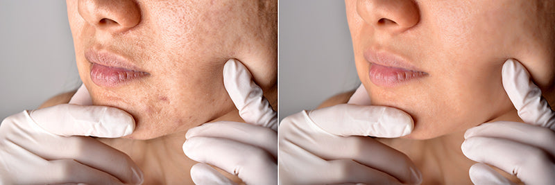 3 Chemical peels