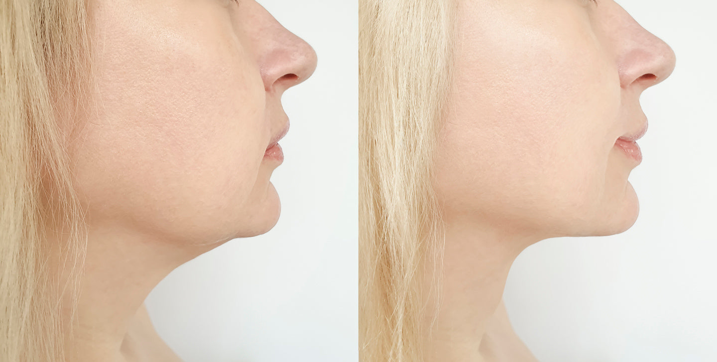 Belkyra Under the chin 2 vials (Not shipped, clinic use only)
