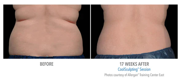 CoolSculpting® 6 Cycles