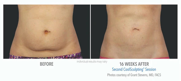 CoolSculpting® 6 Cycles