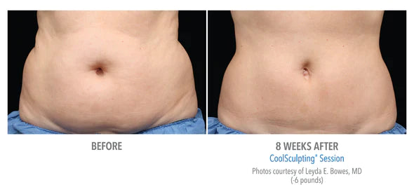 CoolSculpting® 6 Cycles