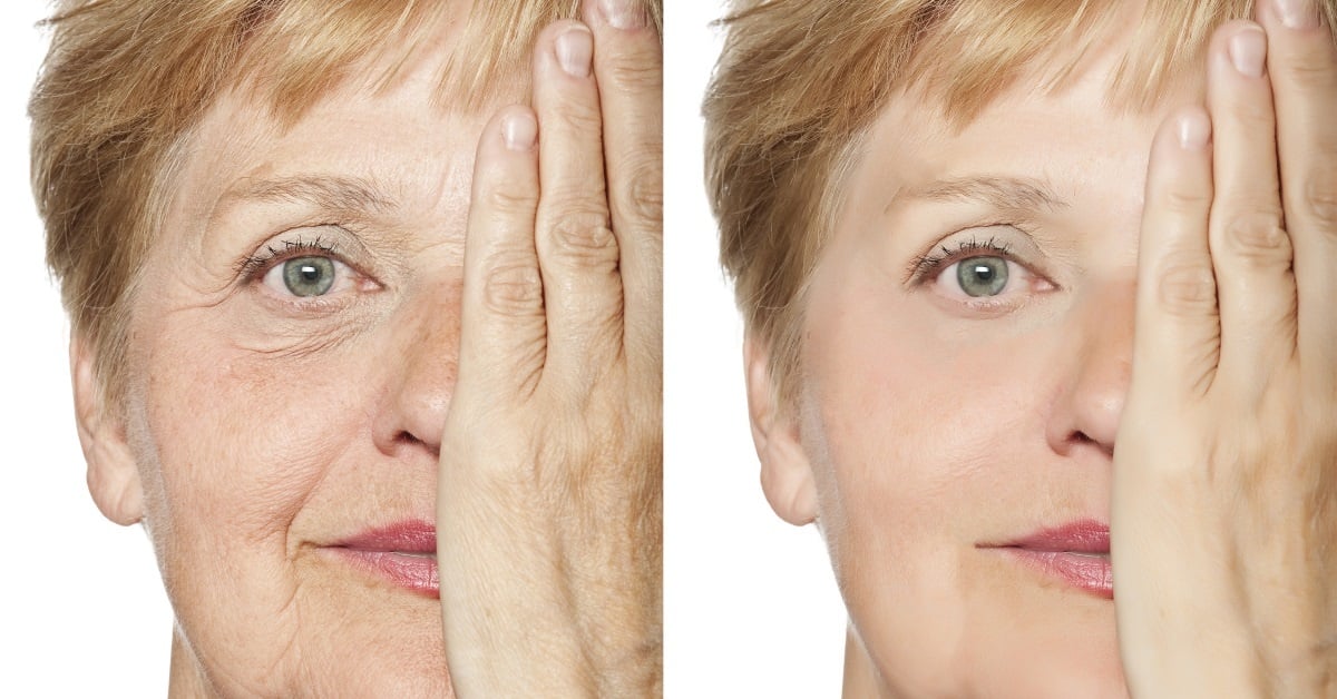 PRF facelift 3 session (clinic use only, not shipped)