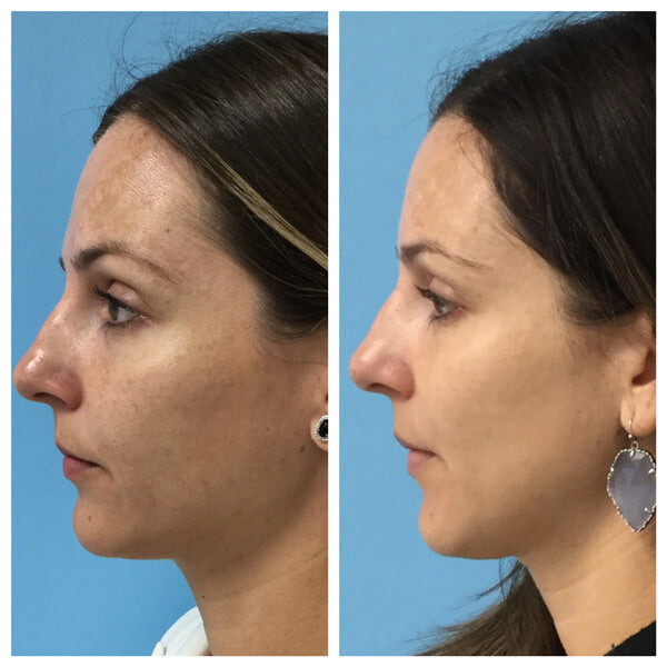 3 Sessions IPL Photofacials