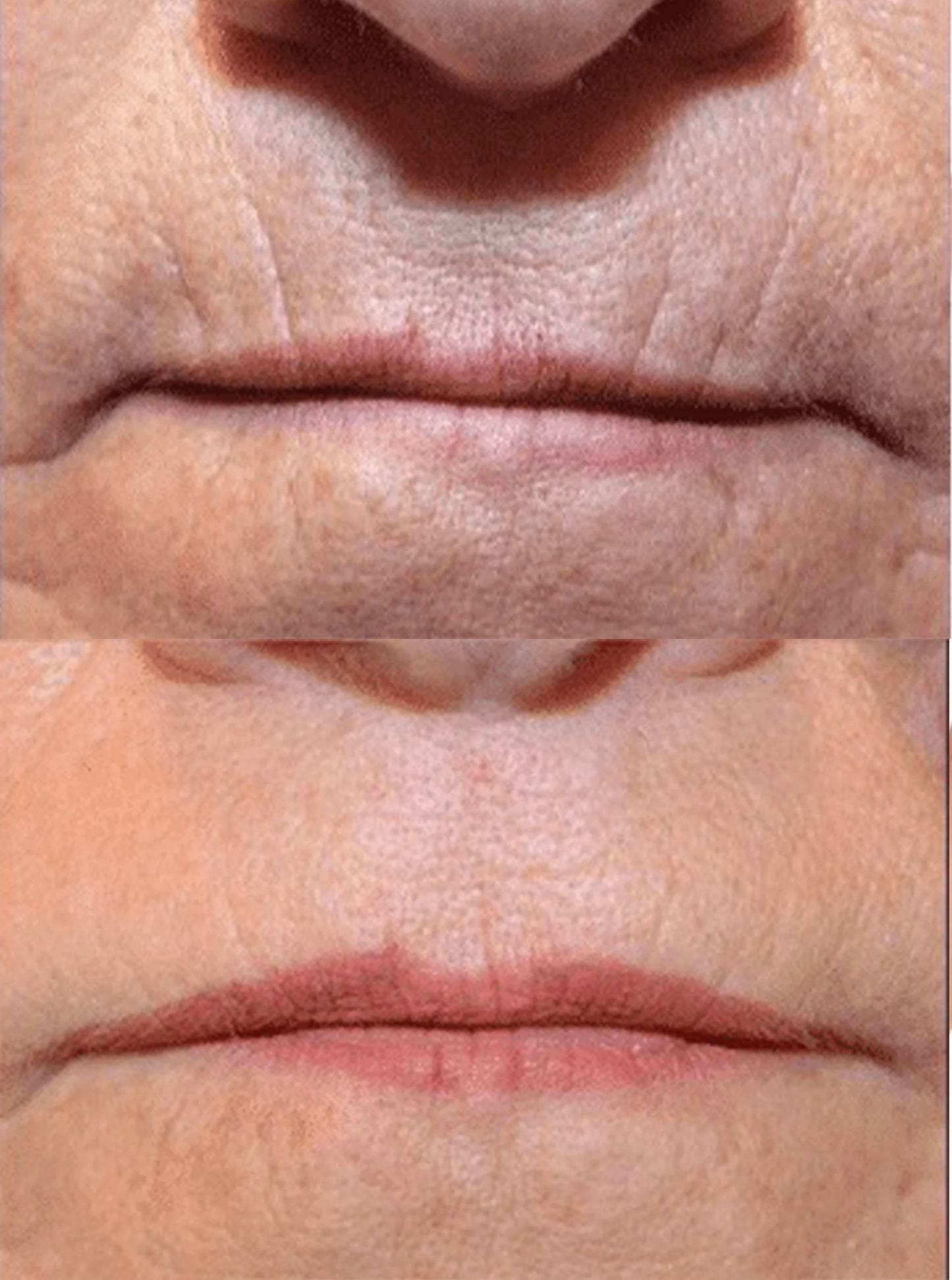 Perioral rejuvenation lip lines/barcode lines/smoker’s lines)