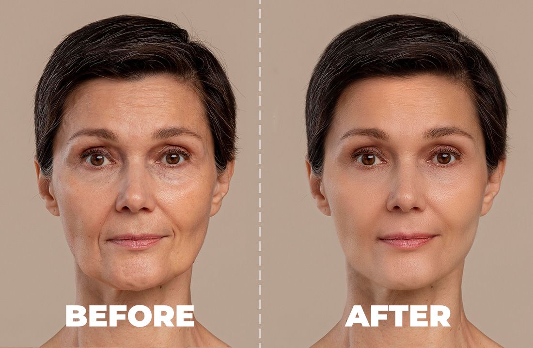 Radiesse Face, Neck or Hand Rejuvenation (not shipped, clinic use only)