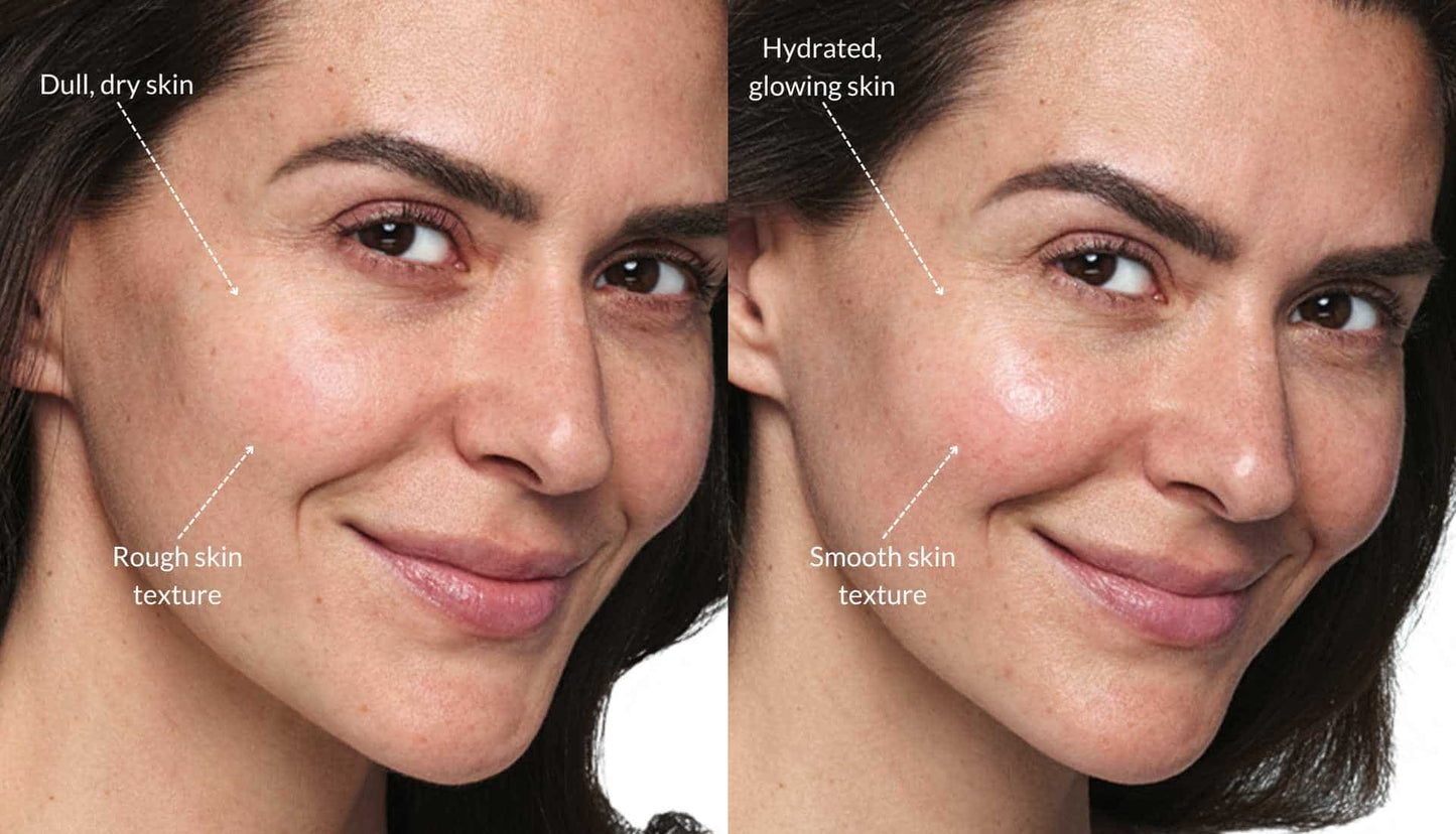 1 Syringe SkinVive Injectable Hyaluronic Acid (Not to be shipped Clinic use only)