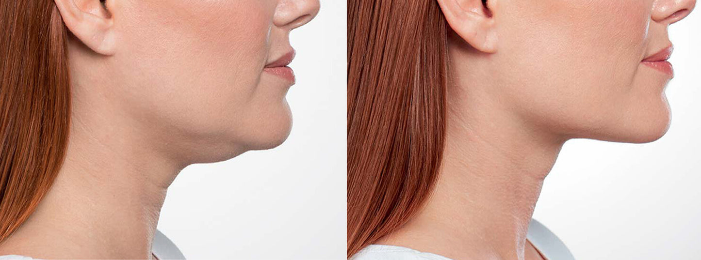 Belkyra Under the chin 2 vials (Not shipped, clinic use only)
