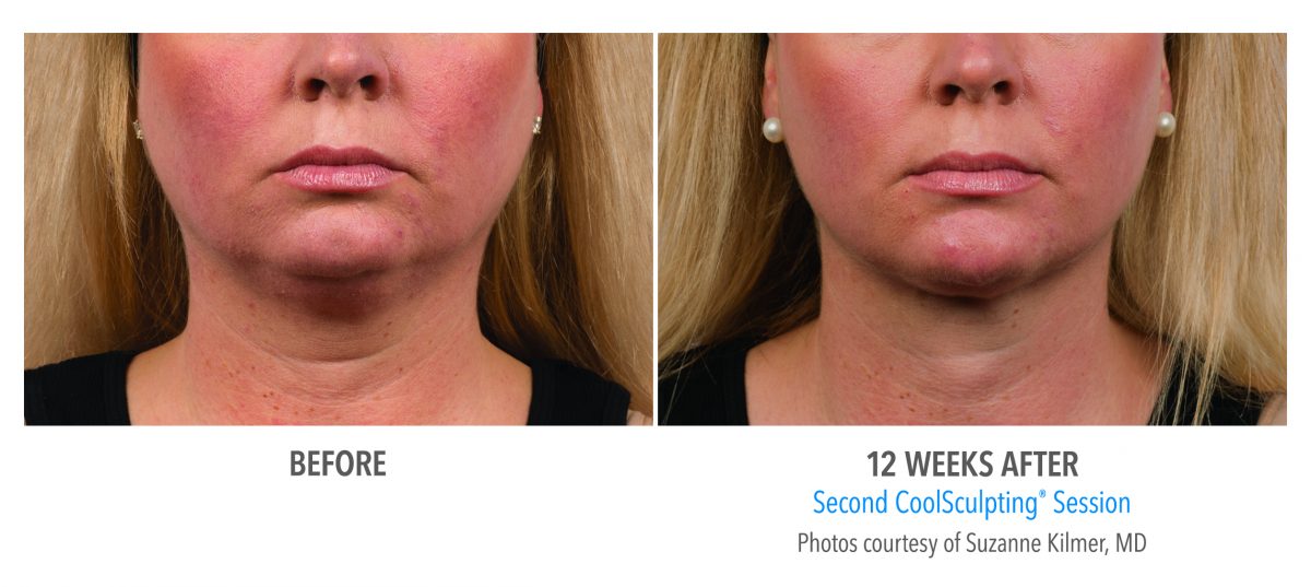 CoolSculpting® Submental 1 Cycle