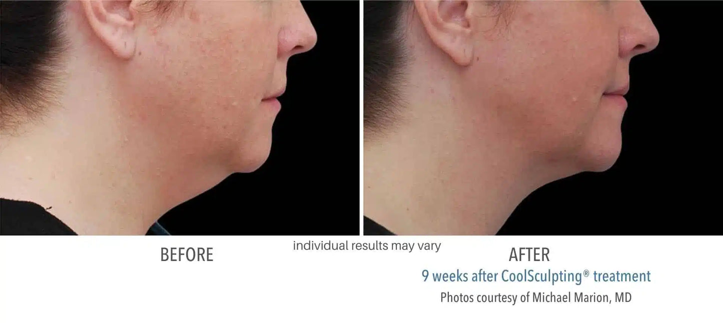 CoolSculpting® Submental 1 Cycle