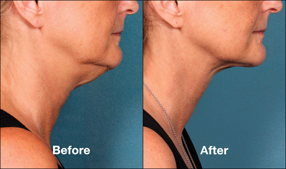 Belkyra Under the chin 2 vials (Not shipped, clinic use only)