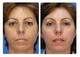 3 Sessions IPL Photofacials