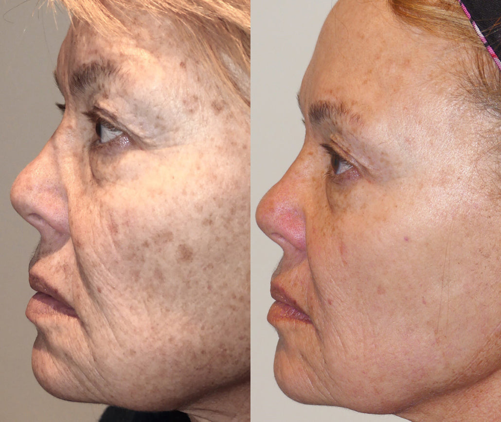 3 Sessions IPL Photofacials