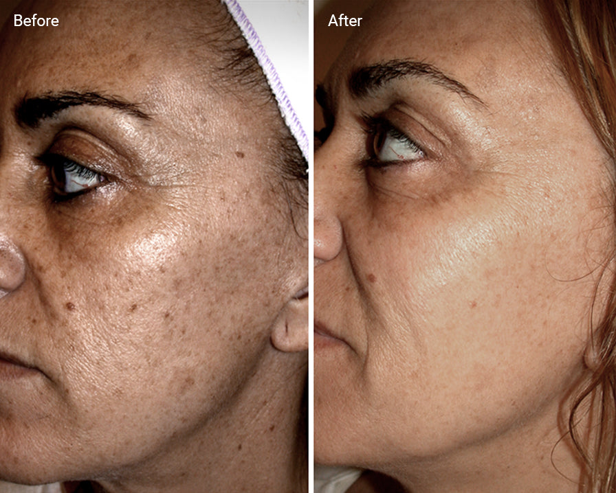 3 Sessions IPL Photofacials