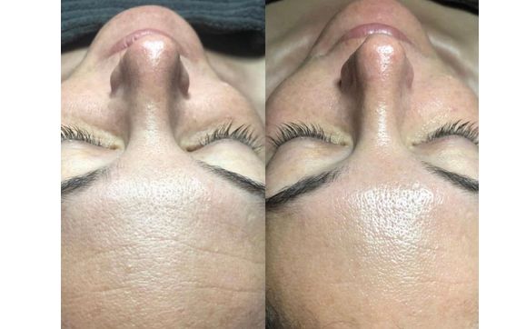 Hydrafacial Facial (Venus Glow Hydrafacial)