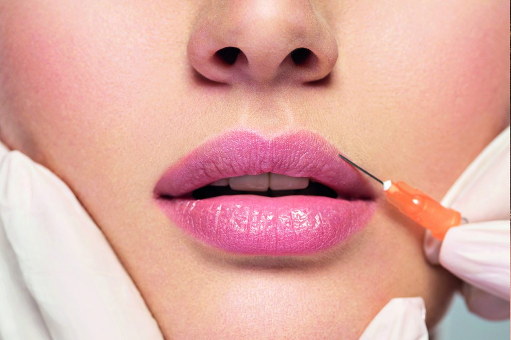 Lip filler 1 syringe Restylane Kysse (not shipped, for clinic use only)