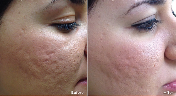 1 SESSION MICRONEEDLING
