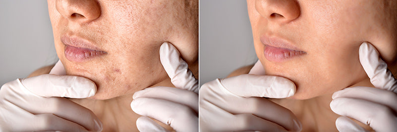 1 Chemical Peel