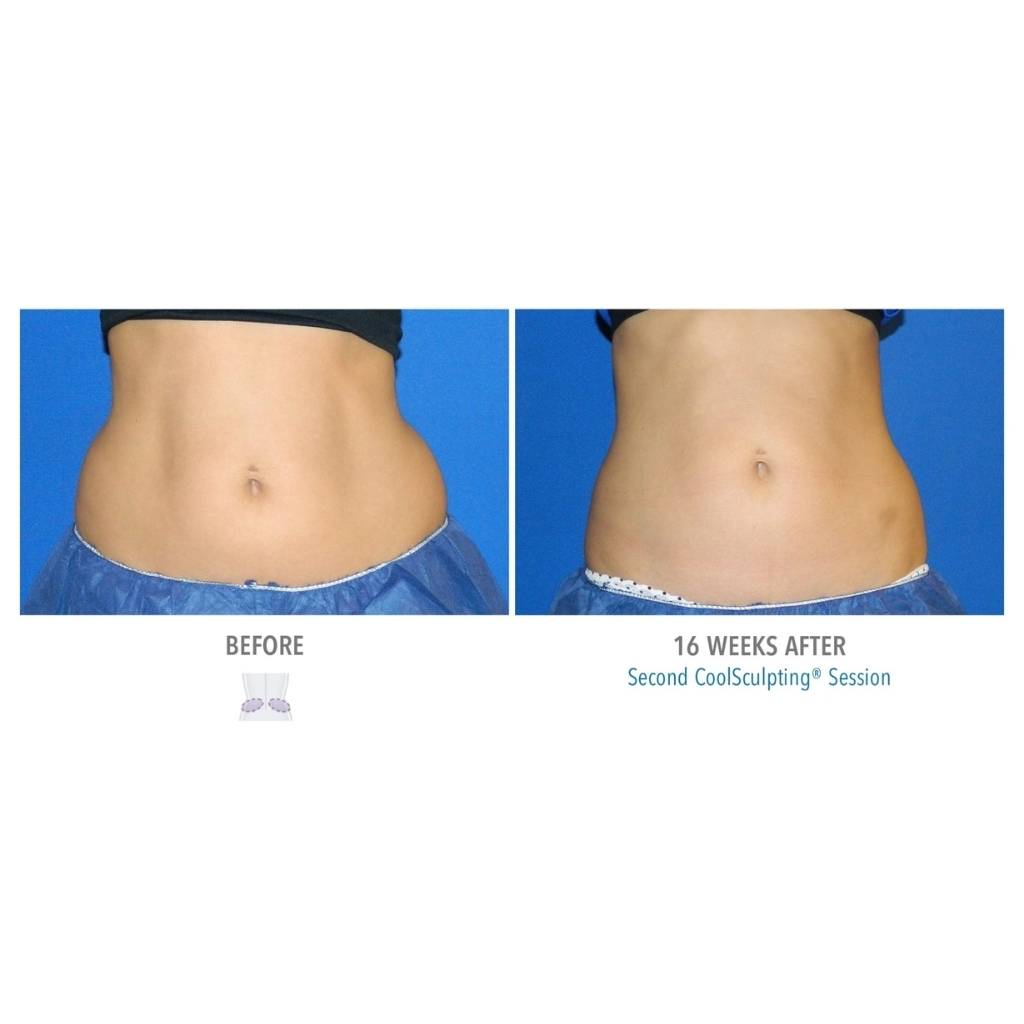 CoolSculpting® 1 Cycles