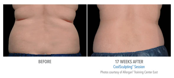 CoolSculpting® 1 Cycle