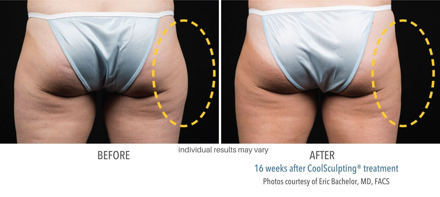 CoolSculpting® Outer thighs 4 Cycles