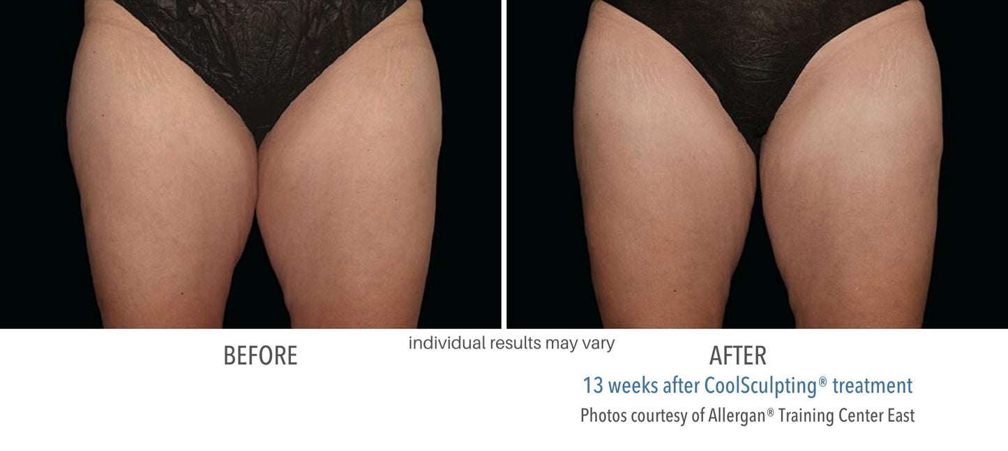 CoolSculpting® Inner thighs 2 Cycles
