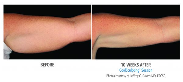 CoolSculpting® Upper Arms 2 Cycles
