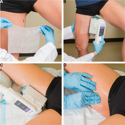 CoolSculpting® Inner thighs 2 Cycles
