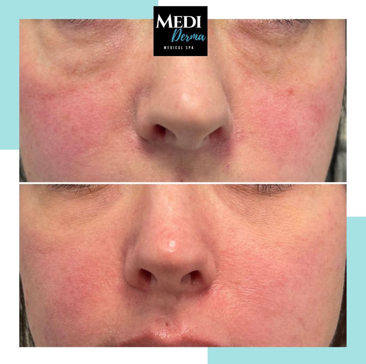 PRF facelift 3 session (clinic use only, not shipped)