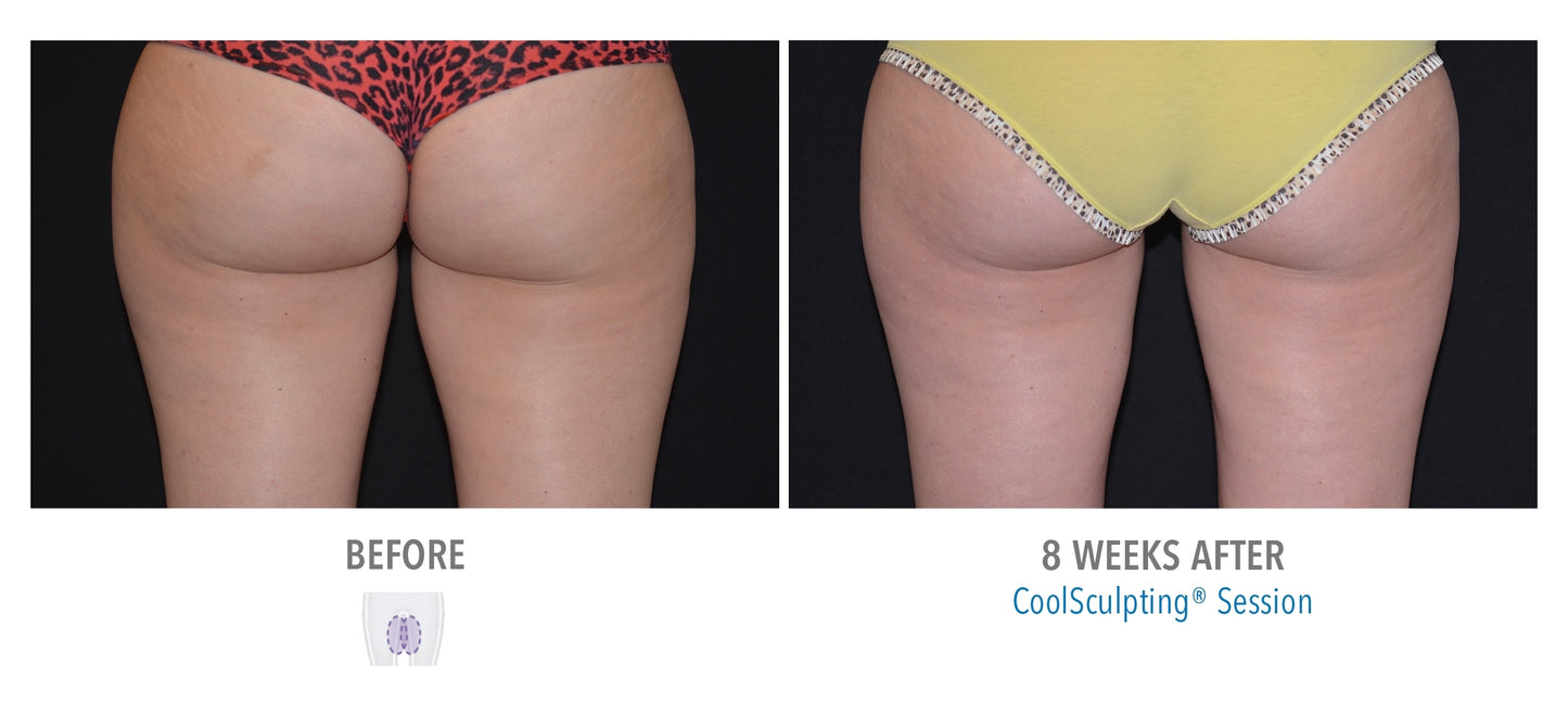 CoolSculpting® Inner thighs 2 Cycles