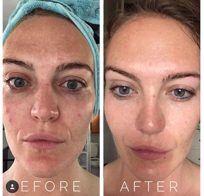 1 SESSION MICRONEEDLING