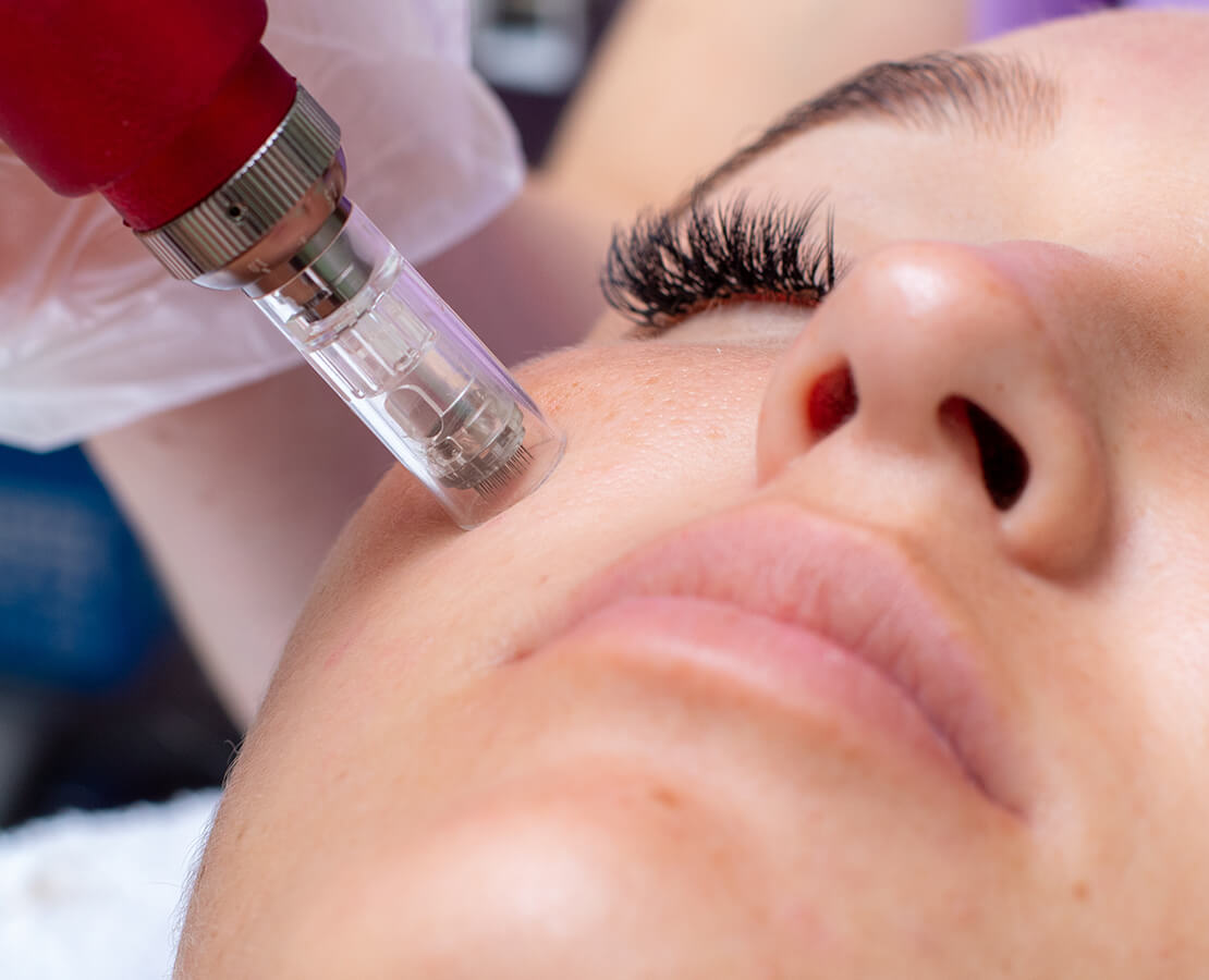 1 SESSION MICRONEEDLING