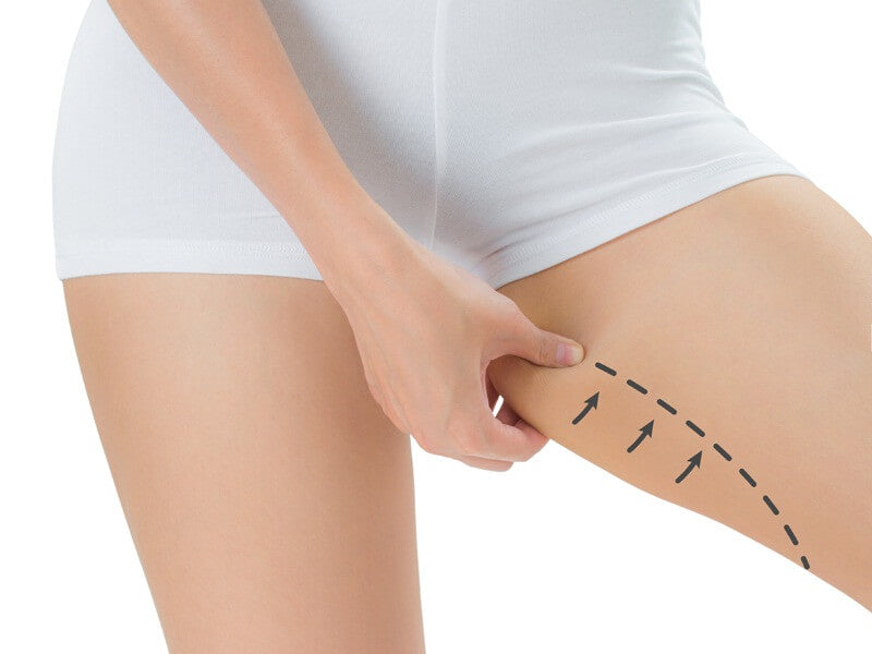CoolSculpting® Inner thighs 2 Cycles