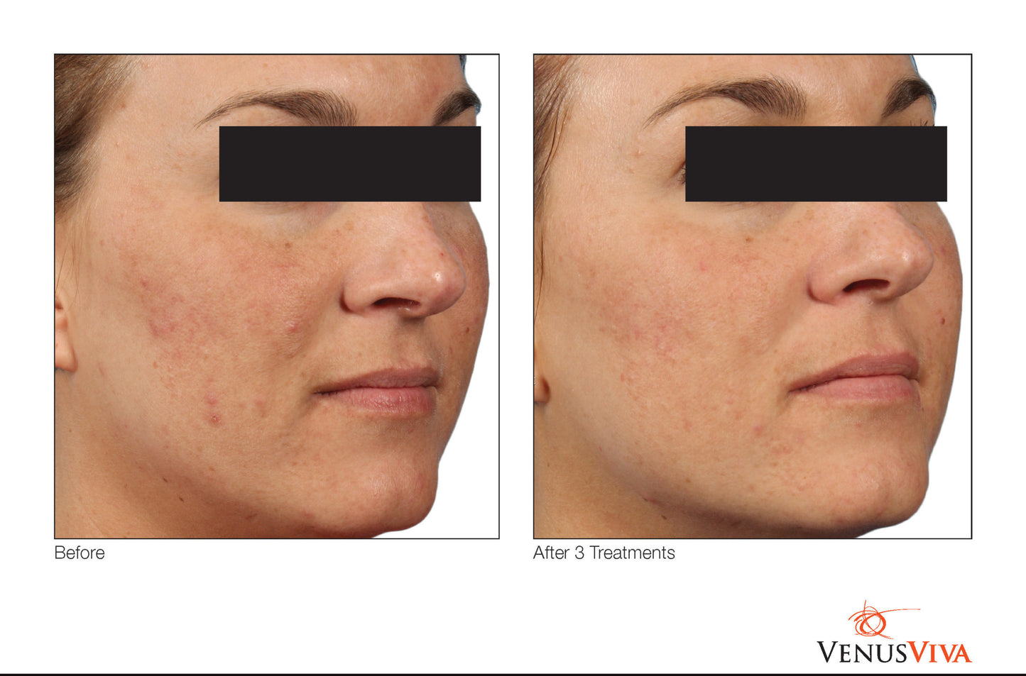 Nano Fractional (skin resurfacing, scars, aging)