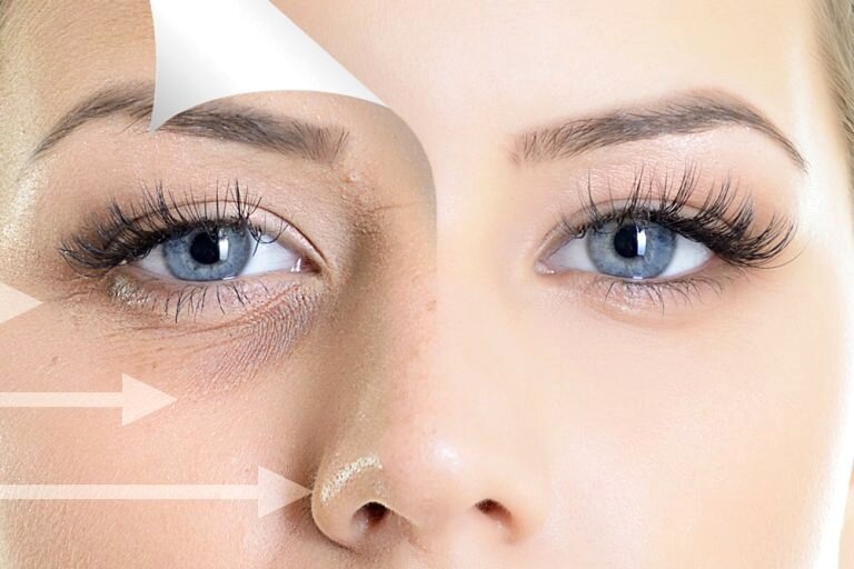PRF facelift 3 session (clinic use only, not shipped)