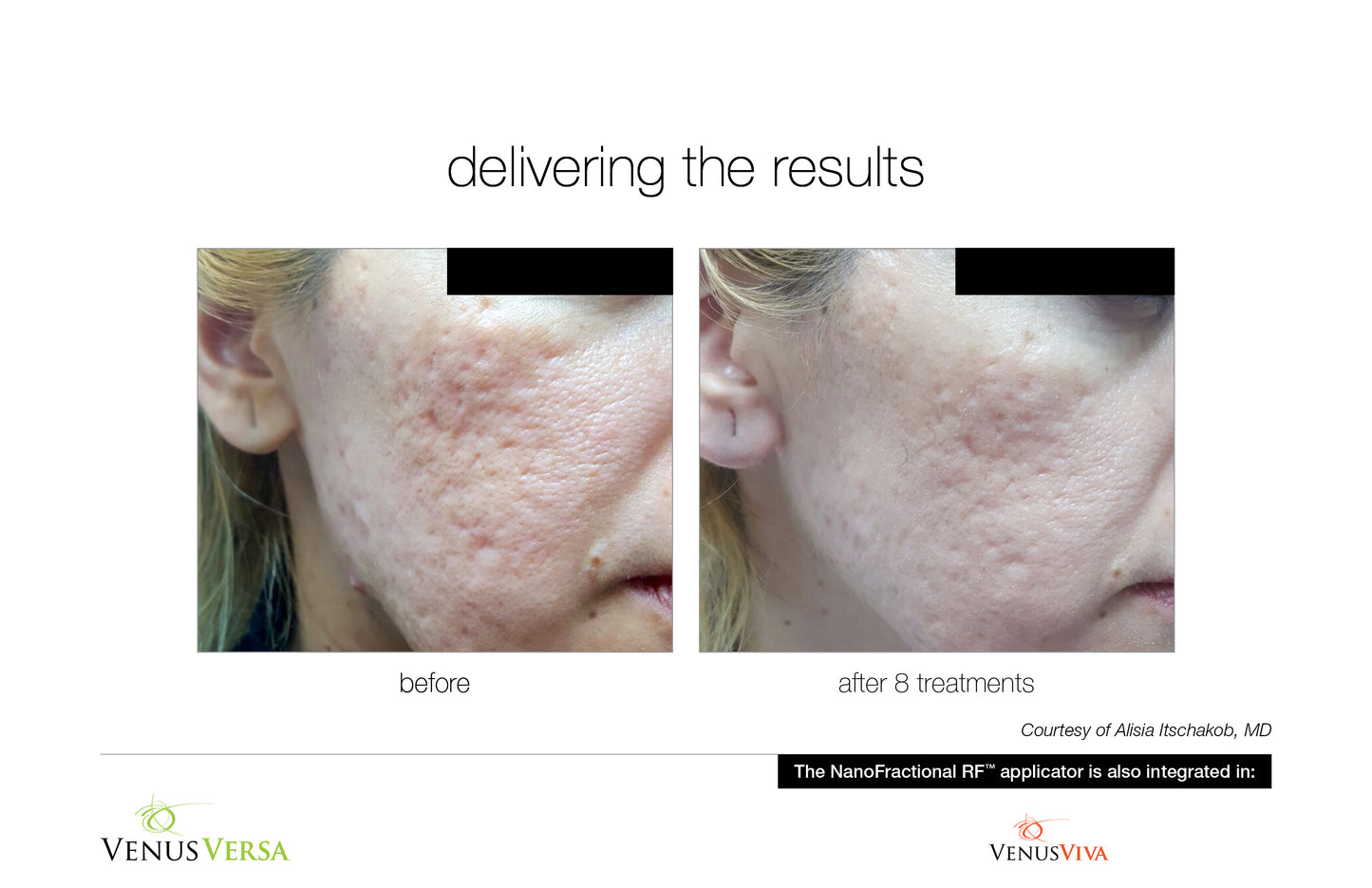 Nano Fractional (skin resurfacing, scars, aging)