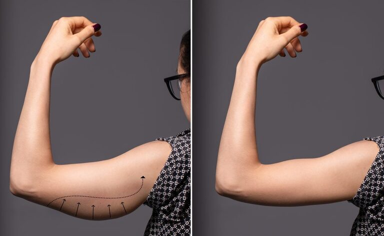 CoolSculpting® Upper Arms 2 Cycles