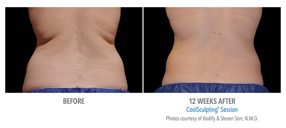 CoolSculpting® 1 Cycles