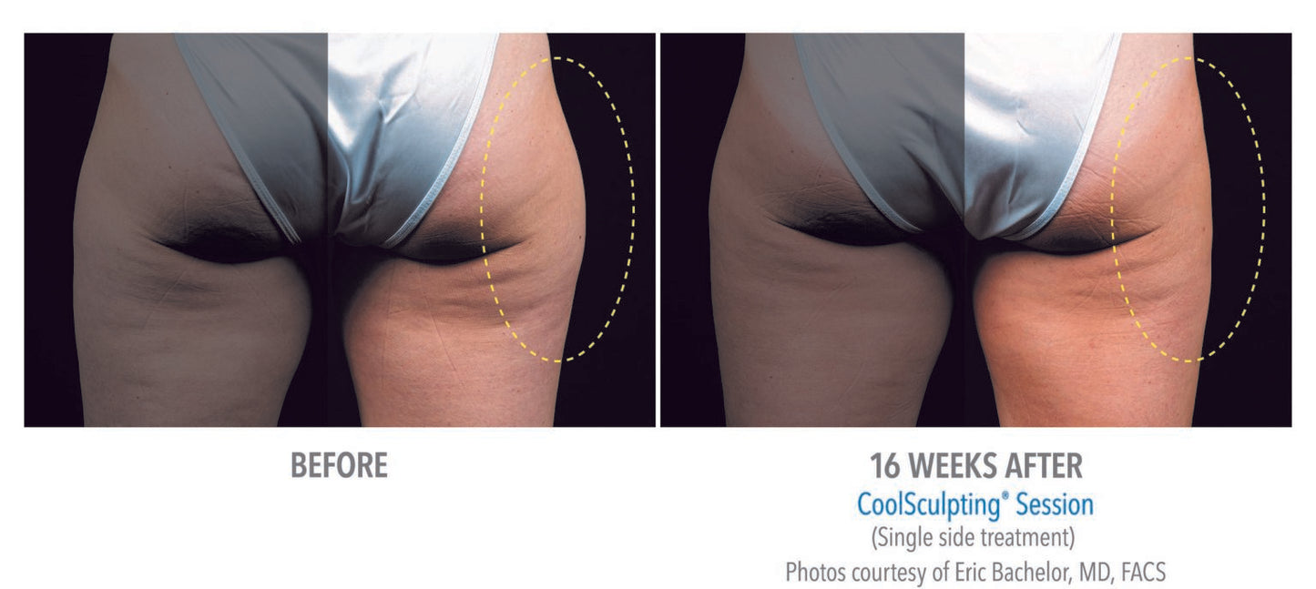 CoolSculpting® Outer thighs 4 Cycles