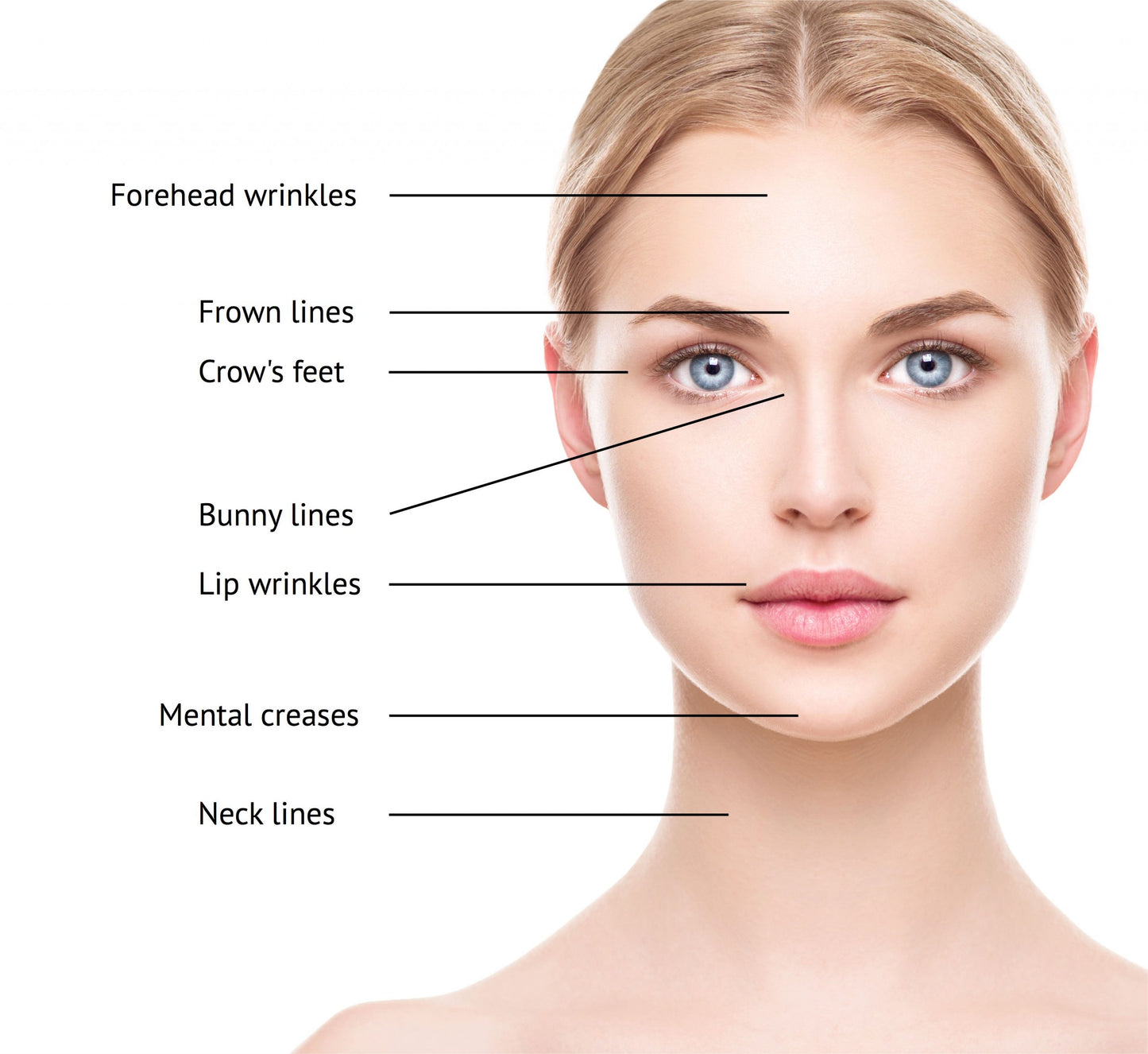 Botox 75 Units (Not shipped, clinic use only)