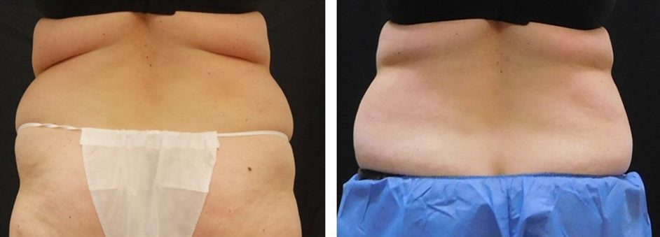 CoolSculpting® 1 Cycles