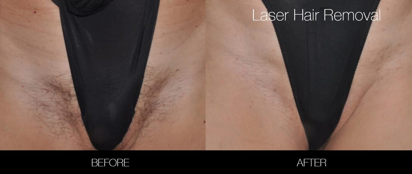 Bikini Laser Hair Removal (Medium area pkg of 6)