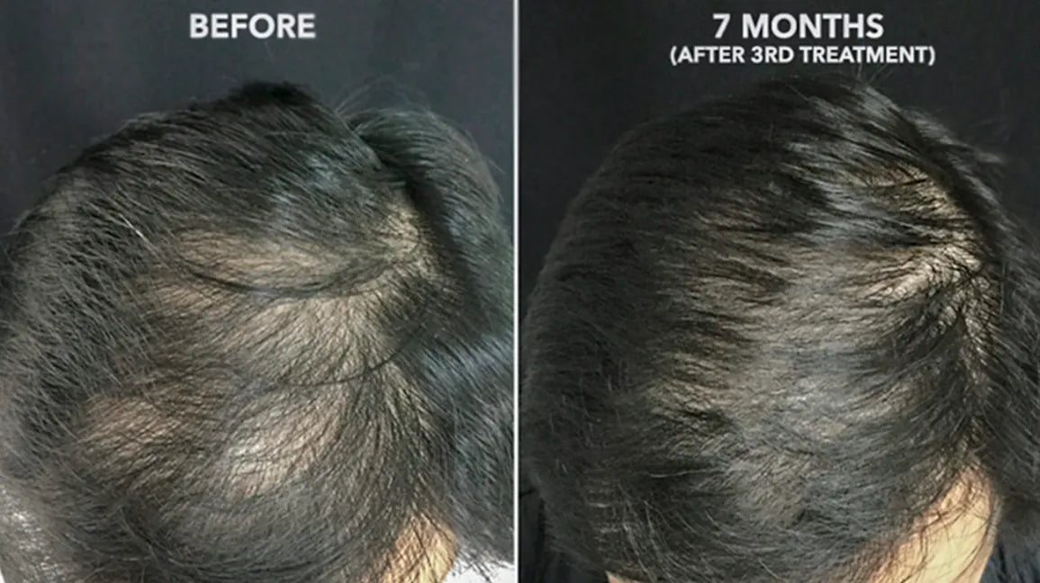 3 SESSIONS PRP (VAMPIRE FACIAL OR HAIR GROWTH)