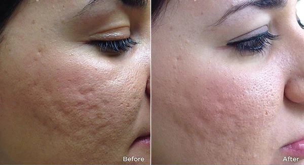 MICRONEEDLING 3 SESSIONS