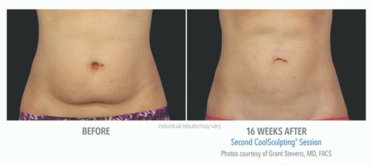 CoolSculpting® 4 Cycles