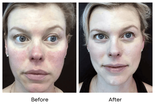 6 Sessions IPL + 2 Free Photofacial