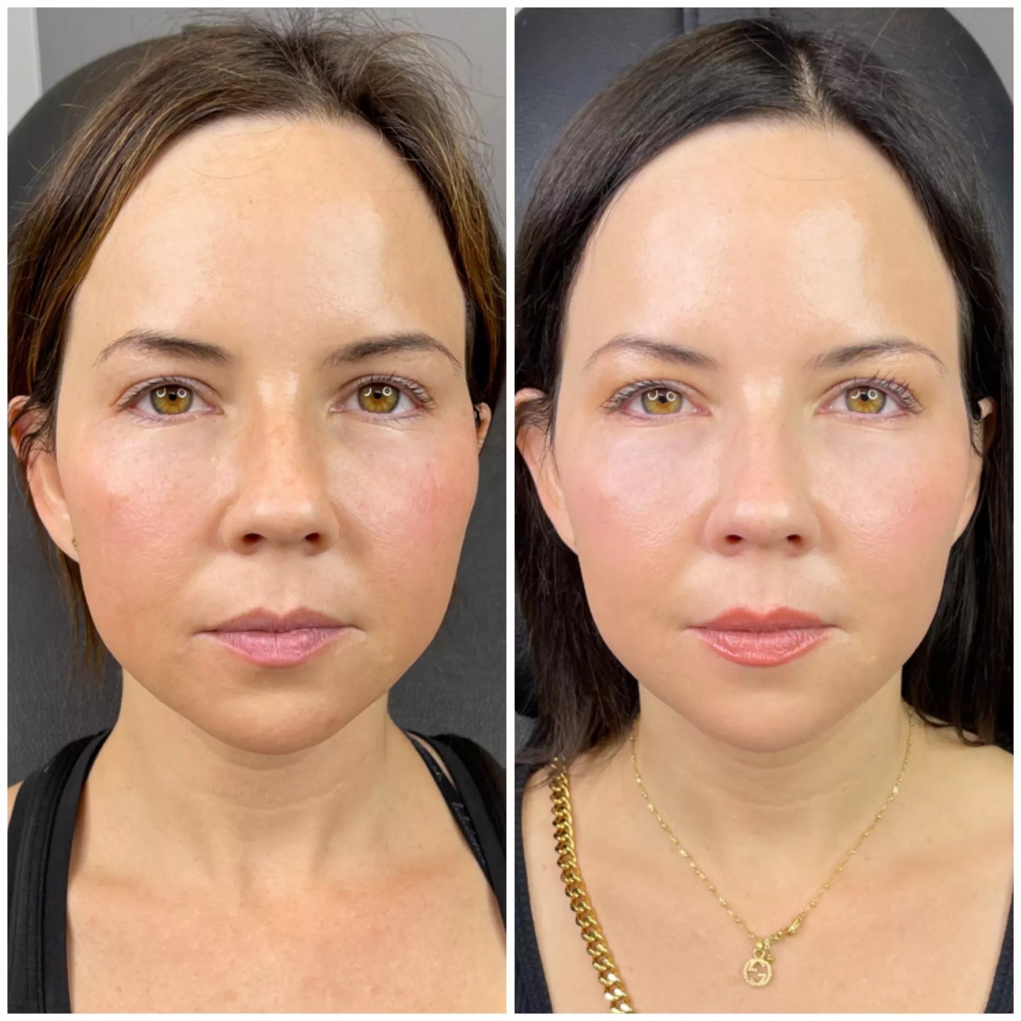 PRF facelift 3 session (clinic use only, not shipped)